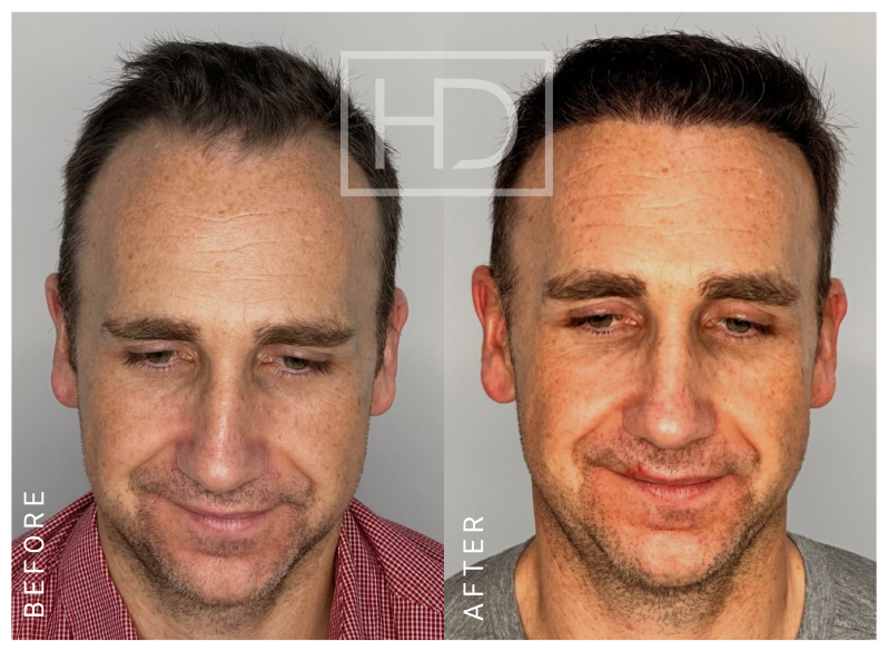 Number of Grafts – 2695Stage of Review – 12 MonthsExpected Full Results – 18 Months