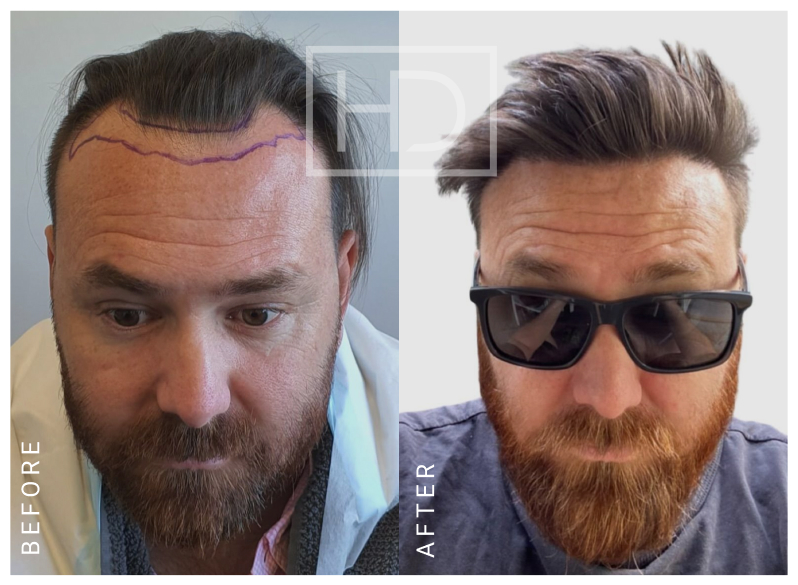 Number of Grafts – 1806Stage of Review – 12 MonthsExpected Full Results – 12 Months