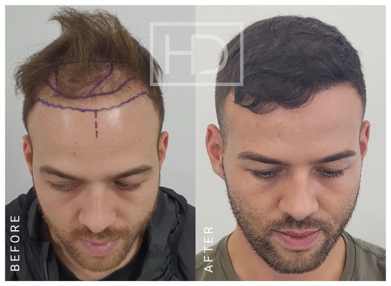 Number of Grafts – 2954Stage of Review – 18 MonthsExpected Full Results – 18 Months