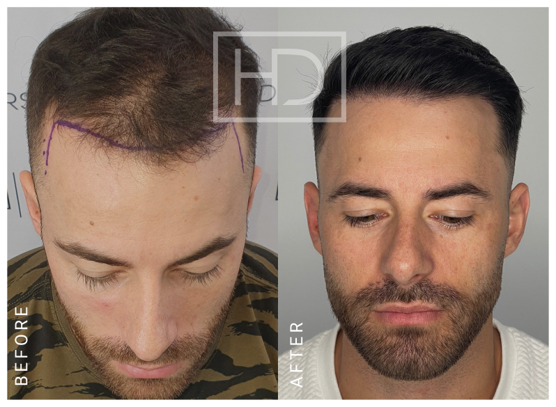 Number of Grafts – 2493Stage of Review – 6 MonthsExpected Full Results – 12 Months