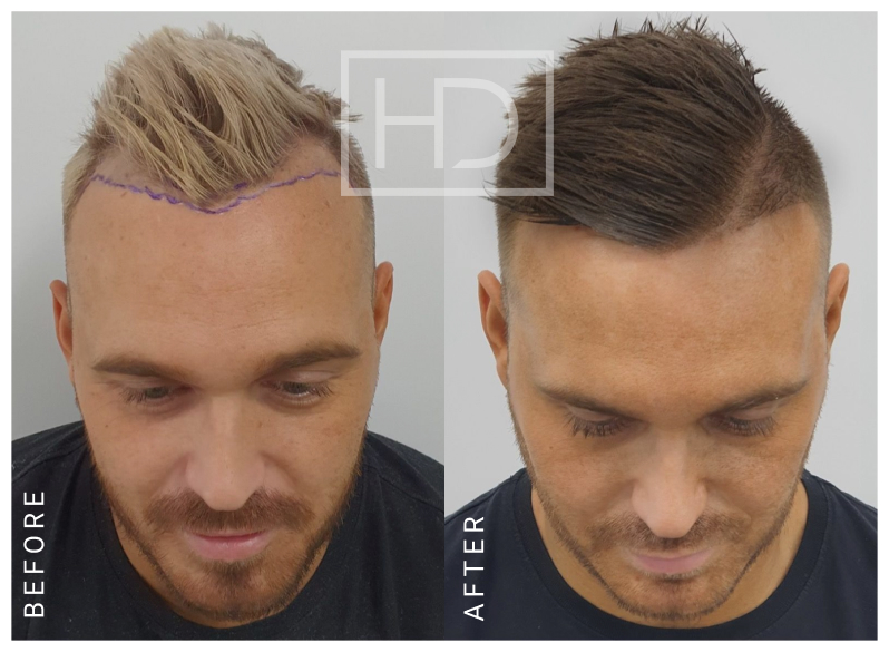 Number of Grafts – 1226Stage of Review – 12 MonthsExpected Full Results – 12 Months